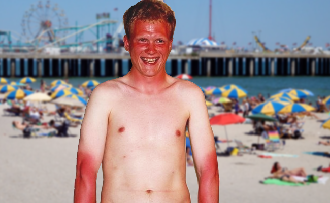 Billedresultat for sunburned beach man